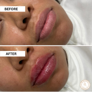 lip enhancement dermal fillers before and after