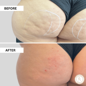 non surgical butt lift before and after