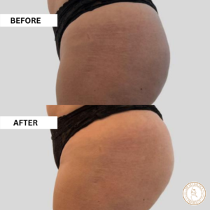 non surgical butt lift before and after