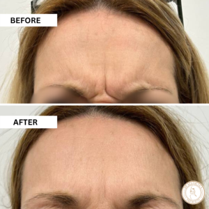 botox injection before and after