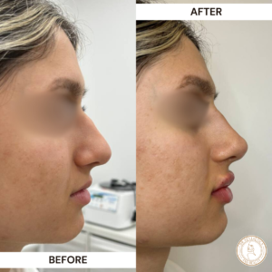 facial contour dermal filler before and after
