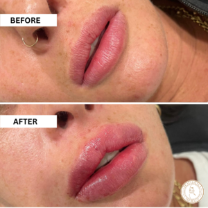 lip contour dermal fillers before and after