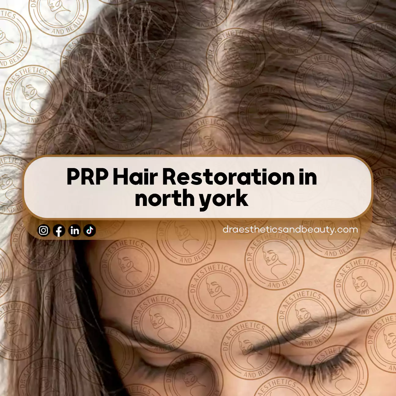 PRP Hair Restoration in north york