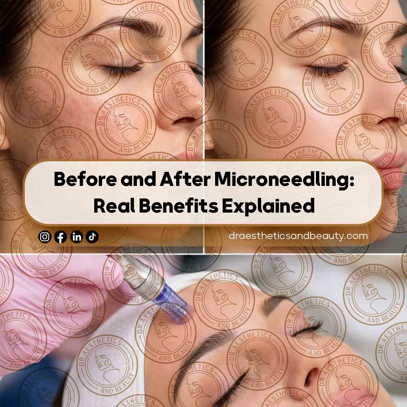 Before-and-After-Microneedling-Real-Benefits-Explained