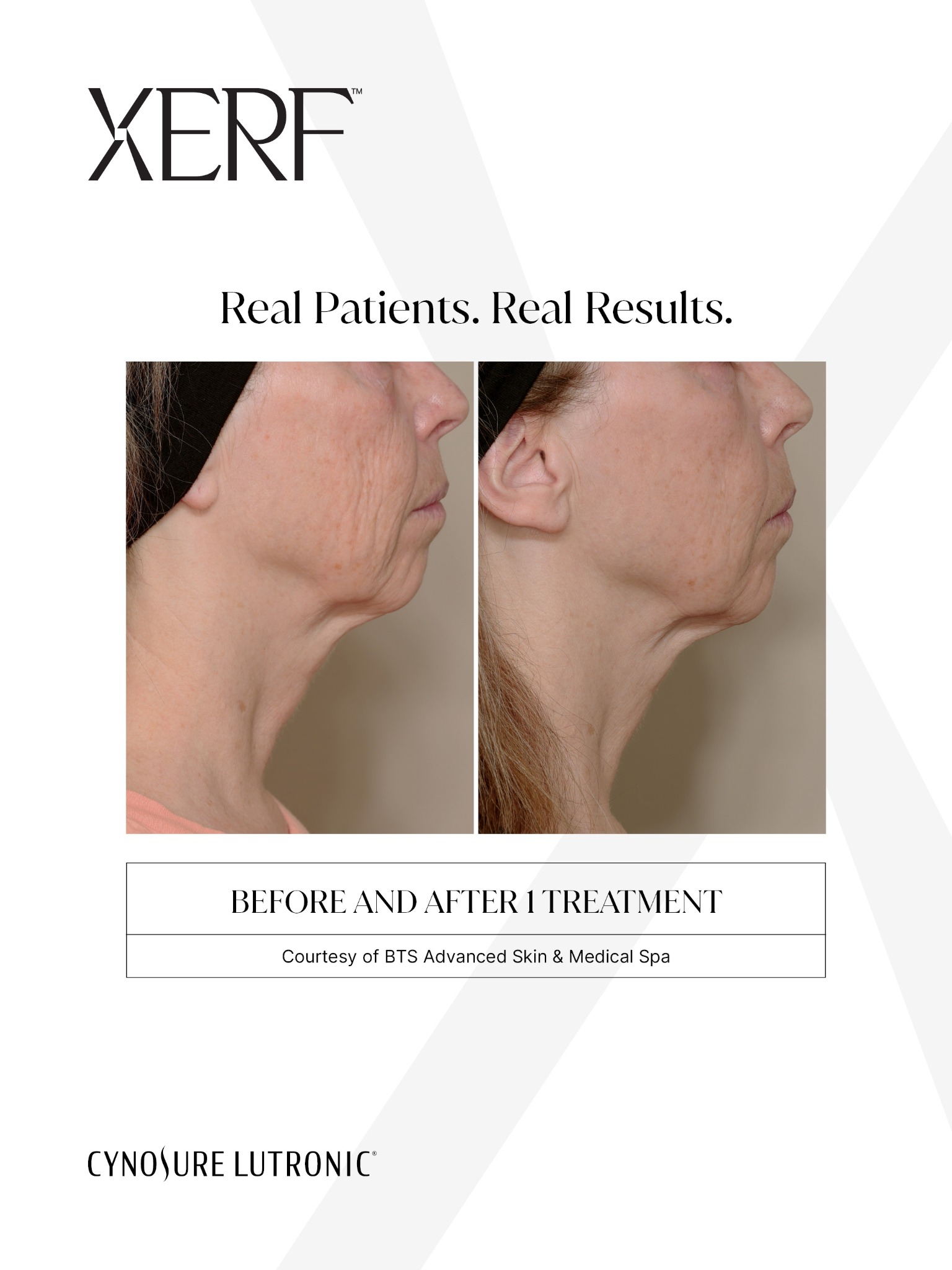 XERF before and after treatment example, courtesy of BTS Advanced Skin and Medical Spa