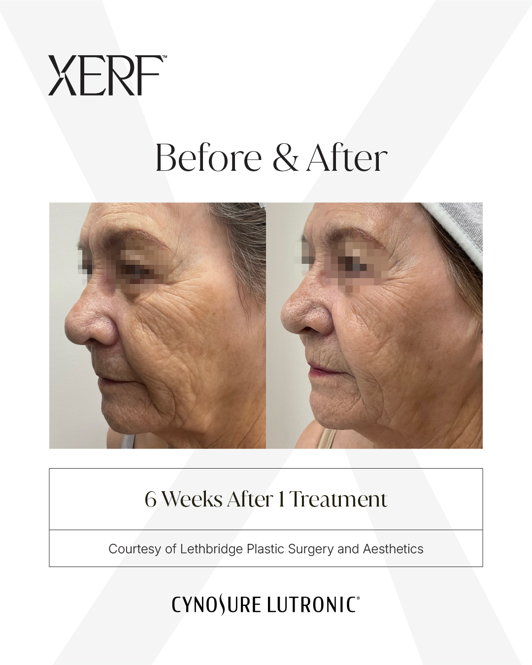 XERF before and after example six weeks after one treatment, courtesy of Lethbridge Plastic Surgery and Aesthetics