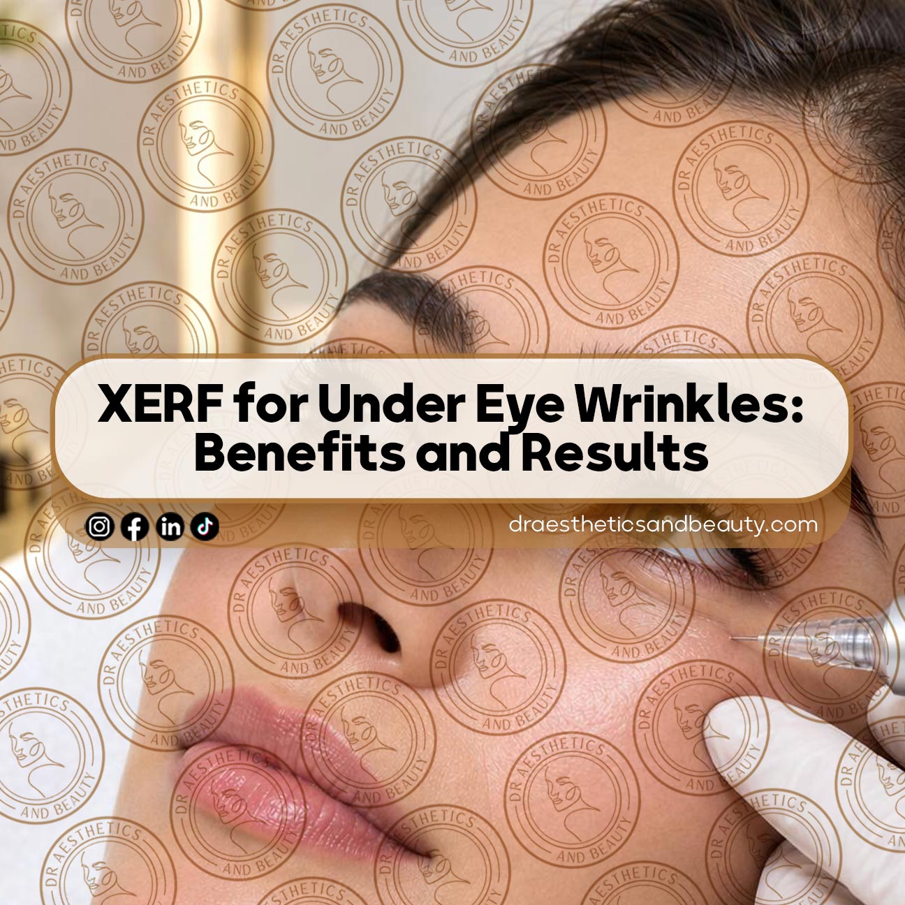 XERF for Under Eye Wrinkles: Benefits and Results